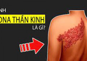 BỆNH ZONA THẦN KINH VÀ NHỮNG ĐIỀU CẦN BIẾT